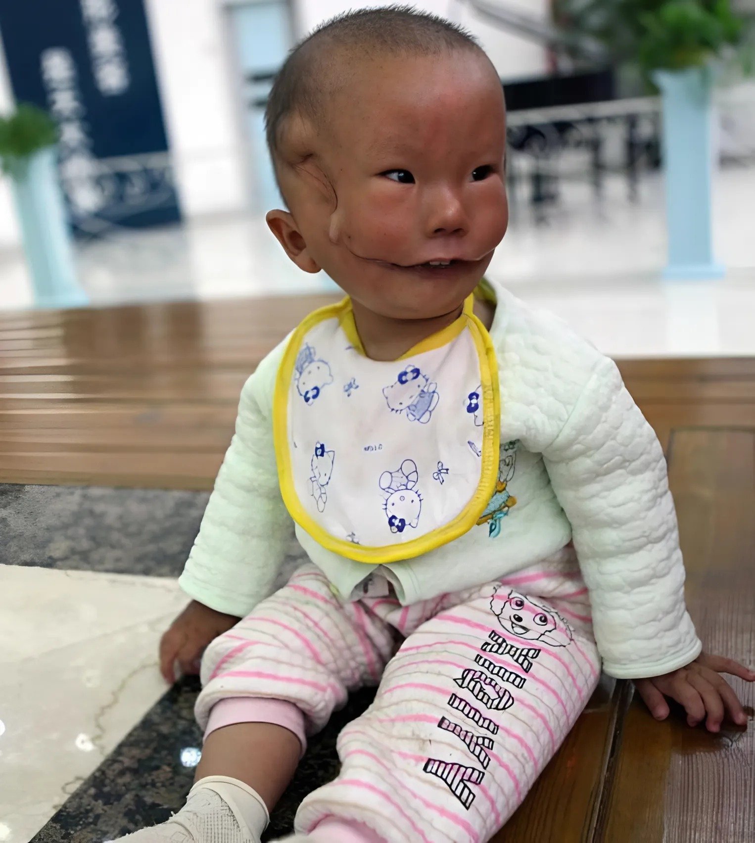 Un garçon au visage inhabituel a subi une opération reconstructive : voici à quoi il ressemble aujourd’hui Un garçon au visage inhabituel a subi une opération reconstructive : voici à quoi il ressemble aujourd’hui