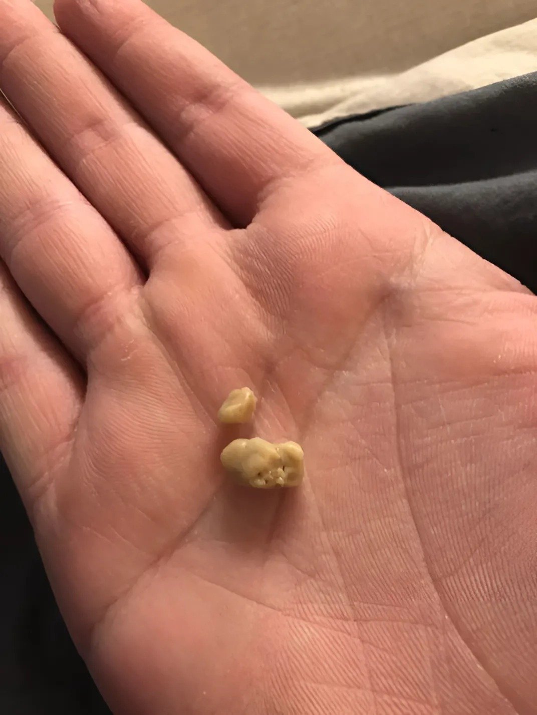 J’ai toussé et un étrange morceau est sorti de ma gorge: En comprenant ce que c’était, je me suis immédiatement adressée à un spécialiste J’ai toussé et un étrange morceau est sorti de ma gorge: En comprenant ce que c’était, je me suis immédiatement adressée à un spécialiste