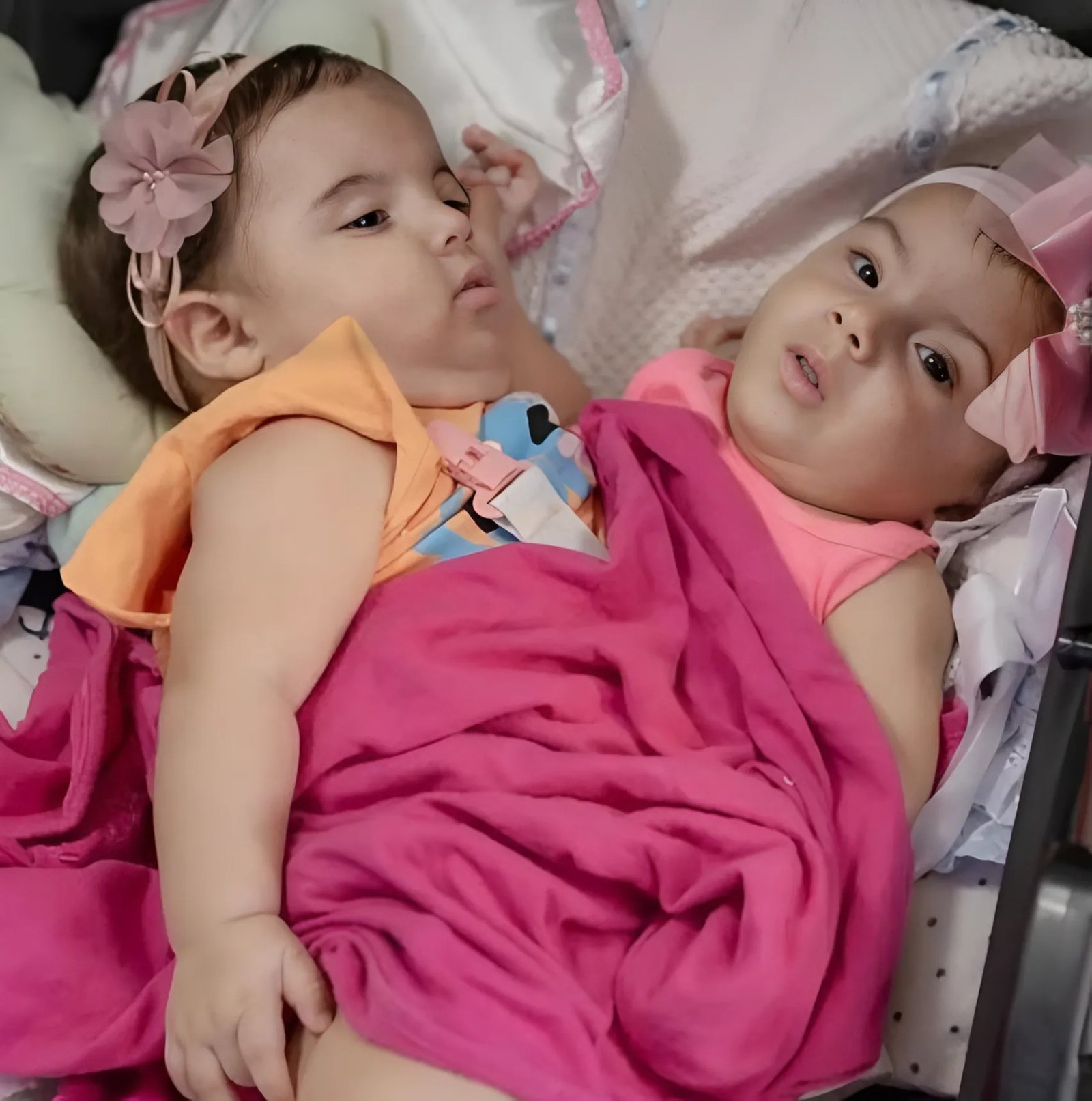 Au Brésil, deux sœurs jumelles siamoises âgées d’à peine 1 an ont été séparées : voici à quoi elles ressemblent aujourd’hui Au Brésil, deux sœurs jumelles siamoises âgées d’à peine 1 an ont été séparées : voici à quoi elles ressemblent aujourd’hui