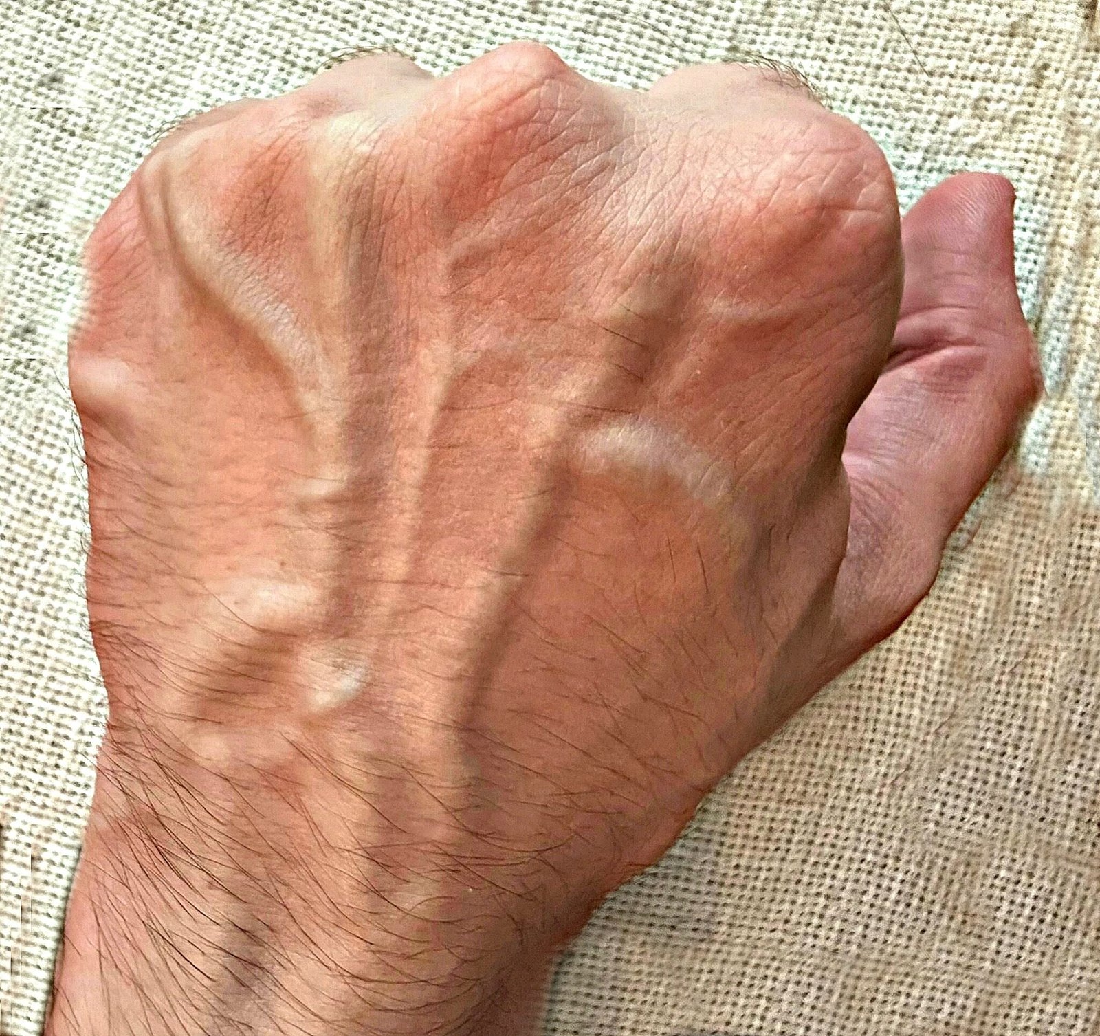 5 problèmes de santé pouvant provoquer des veines visibles